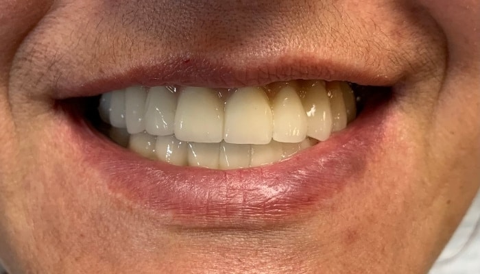 Teljes fogsor implantátum fogakkal